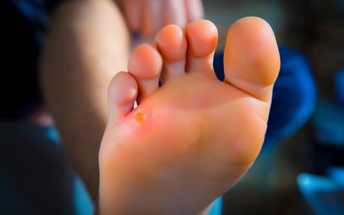 Why Foot Corns Develop in Certain Spots